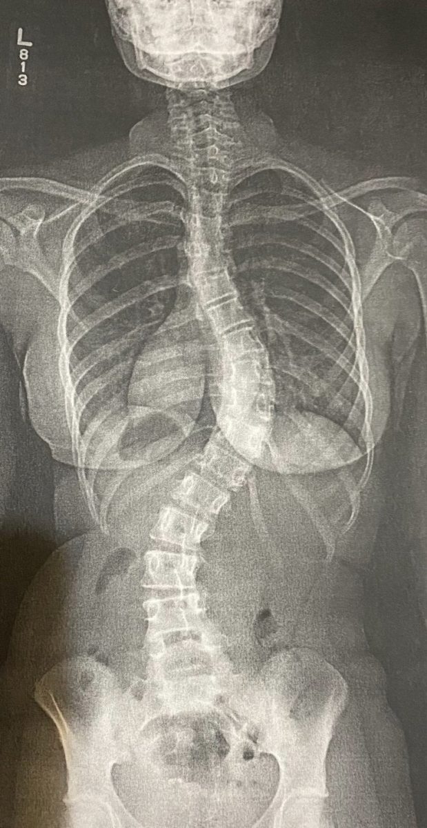 The X-Ray shows the misalignment of my spine before the operation. (Gloria Chilewa)